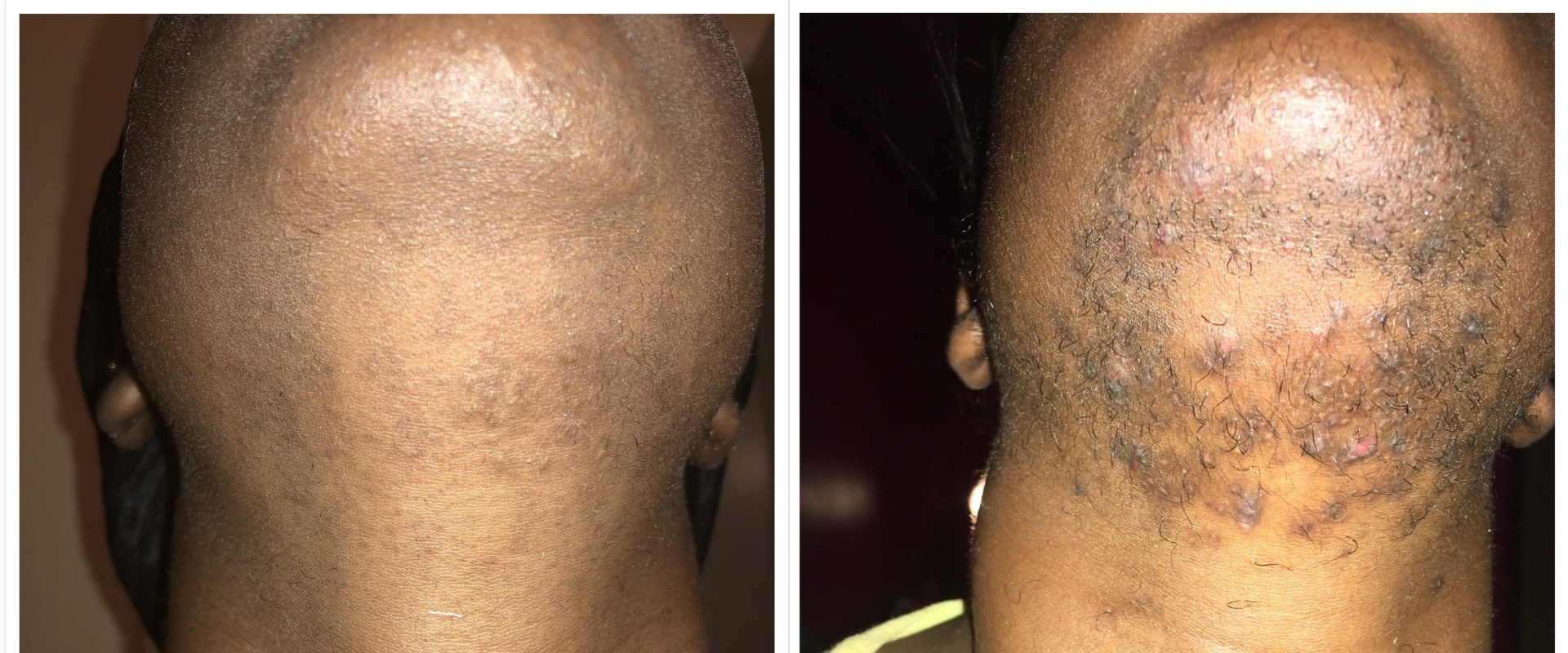 Top 5 Professional Laser Hair Removal Machines