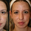 How Long Does It Take to See Results After Laser Hair Removal Treatment?
