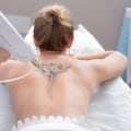 Laser Hair Removal on People with Tattoos or Permanent Makeup: What You Need to Know