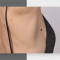 Laser Hair Removal on People with Moles, Freckles, or Birthmarks: What You Need to Know