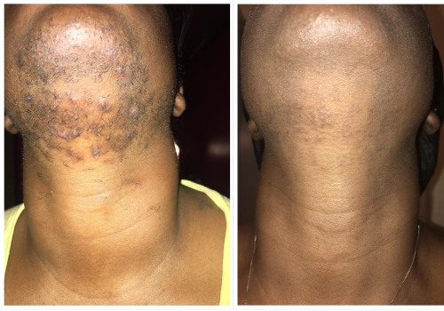 How Long Does It Take for Hair to Grow Out After Laser Hair Removal?
