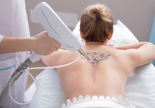 Laser Hair Removal on People with Tattoos or Permanent Makeup: What You Need to Know