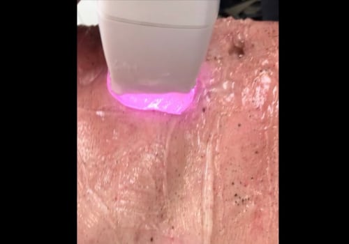 How Long Does Laser Hair Removal Last on the Vagina? - A Comprehensive Guide