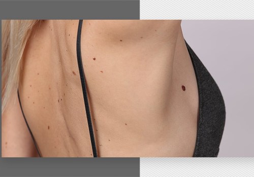 Laser Hair Removal on People with Moles, Freckles, or Birthmarks: What You Need to Know